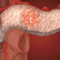 Панкреонекроз: симптомы, диагностика, причины и лечение