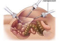 Лапароскопия поджелудочной железы при панкреатите