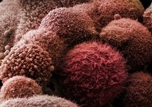 Клетка рака поджелудочной железы