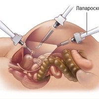 Лапароскопия поджелудочной железы при панкреатите