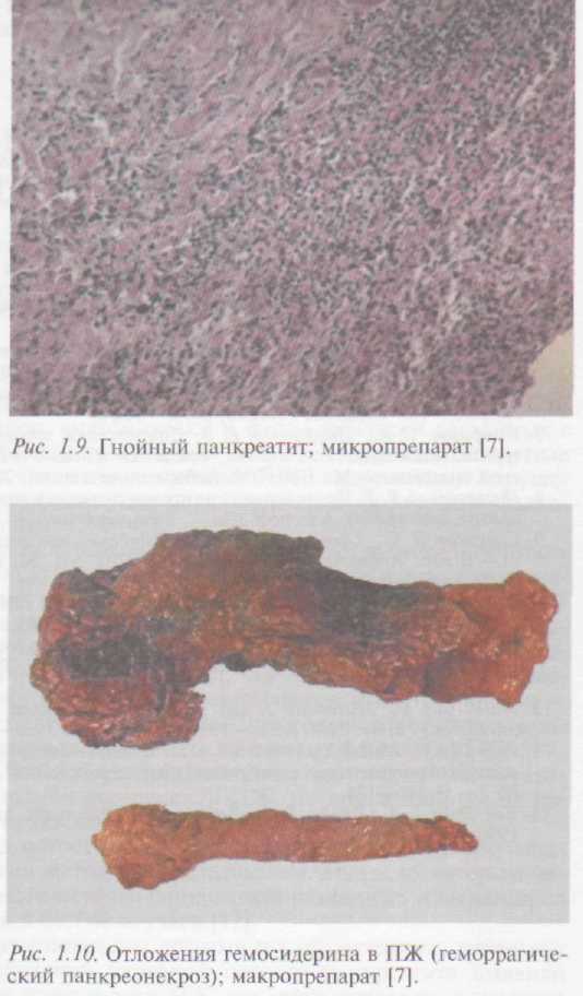 Отложения гемосидерина в Поджелудочной железе, геморрагический панкреонекроз